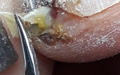 Lesión por onicomicosis