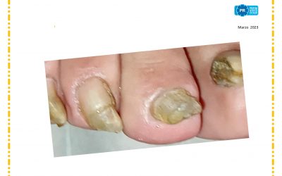 Onicomicosis