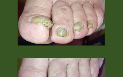 Onicomicosis y distrofia