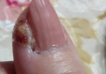 Infección alrededor de la uña