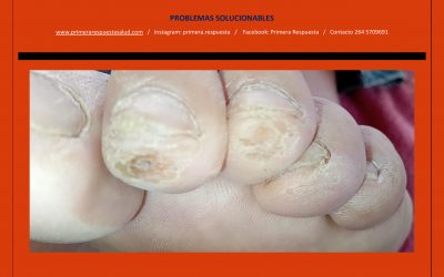 Problemas solucionables en uñas y en la piel