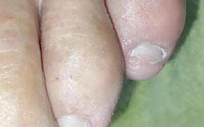 Uñas y pie diabético sanos