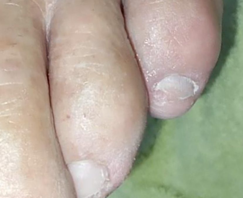 Uñas y pie diabético sanos