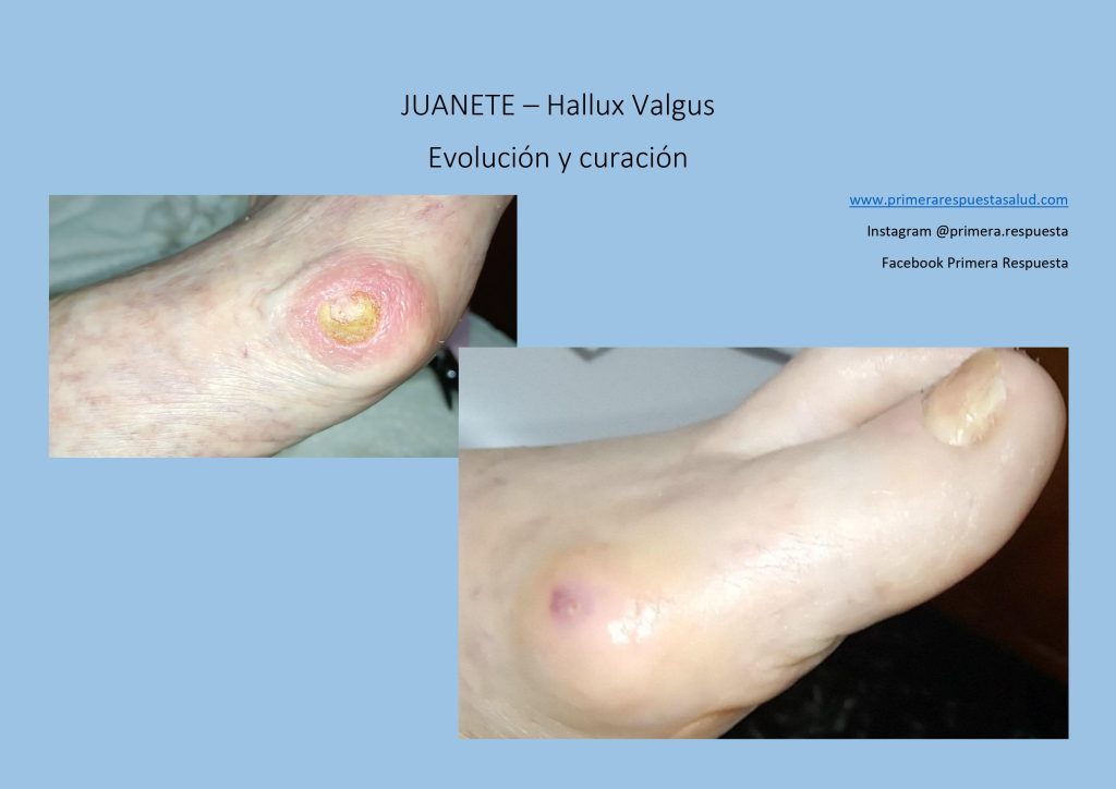 Cuidados permanentes para hallux valgus.
San Juan. 2025