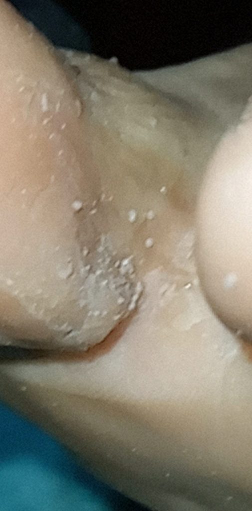 micosis interdigital