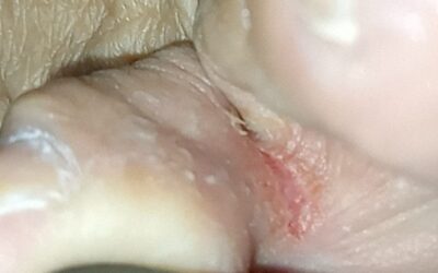 Micosis pédica.