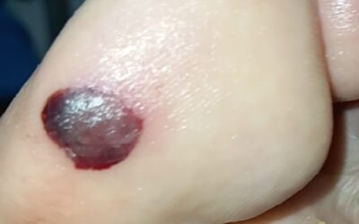 Hematomas y enfermedades de base.