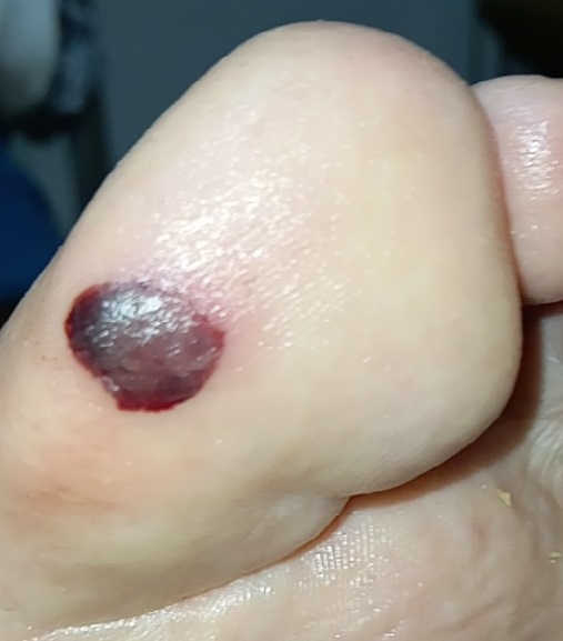 Hematomas y enfermedades de base.
