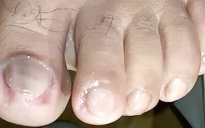 dolor en las uñas?