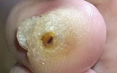 Callo por dedo martillo