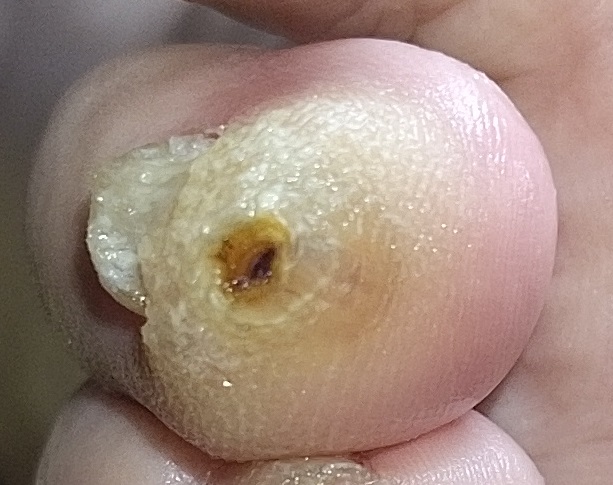 Callo por dedo martillo