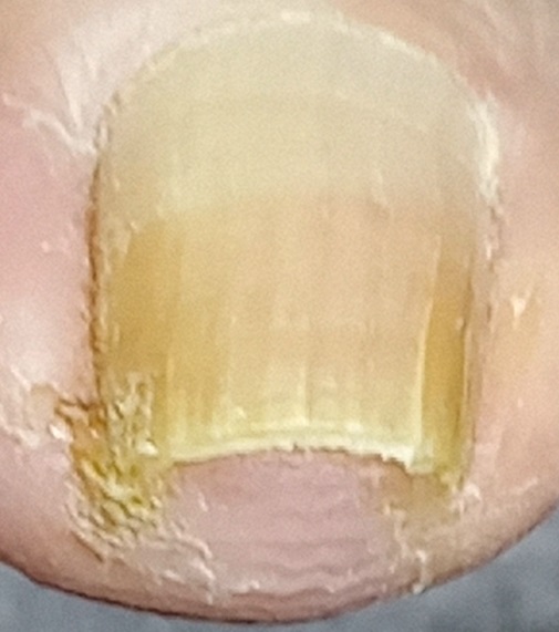 Onicocriptosis con infección.
