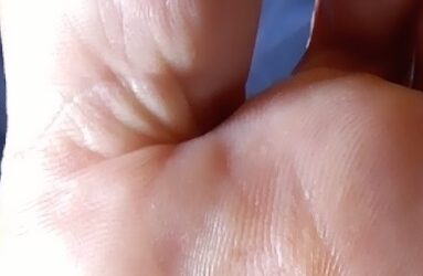 Quiropodia