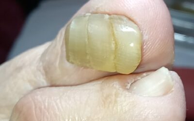 Hiperqueratosis