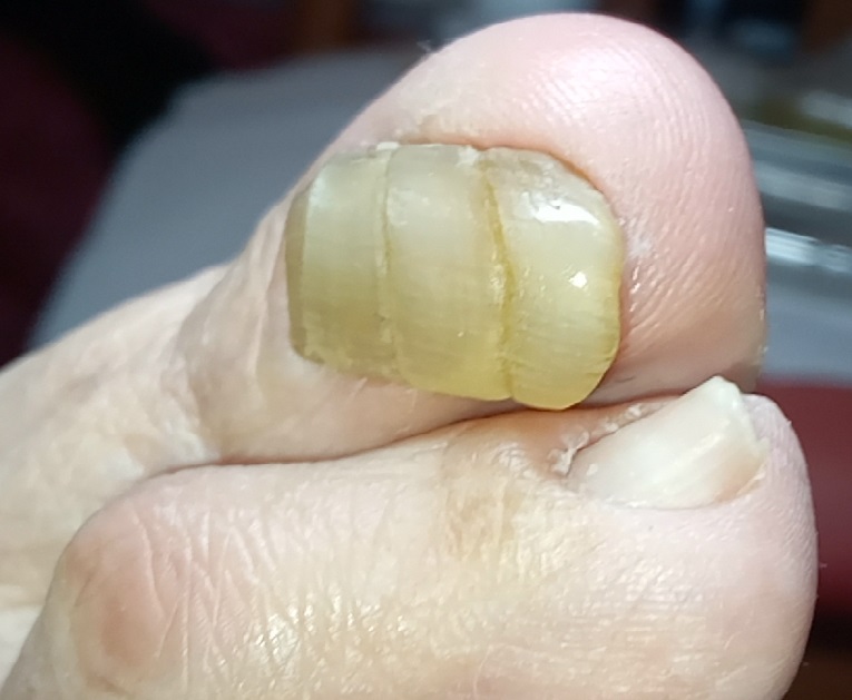 Hiperqueratosis