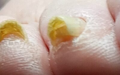 Este aspecto de las uñas debe ser corregido.