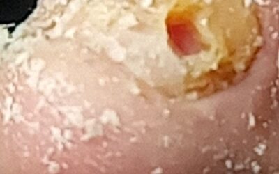 Infección bacteriana y micótica en uña.