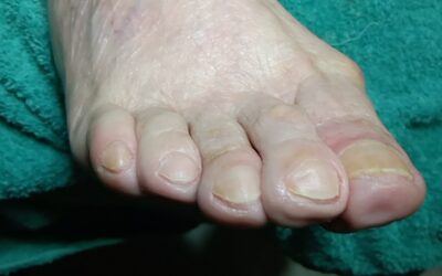 Efectos del mal apoyo de los pies