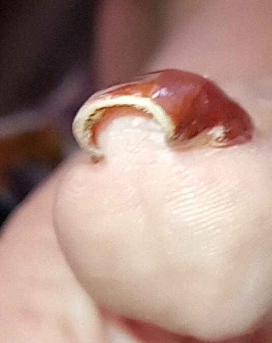 Uña que provoca dolor y lesiones