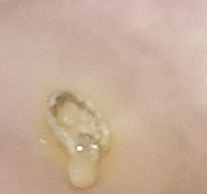 Infección peligrosa por la ausencia de síntomas.