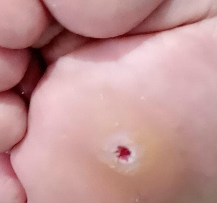 Hallazgo en podología