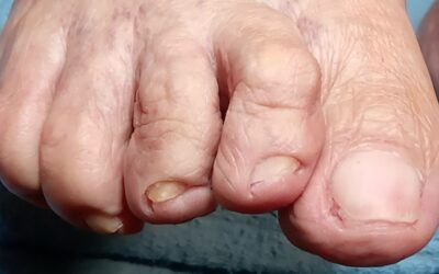 Deformación de los dedos de los pies