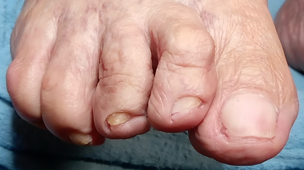 Deformación de los dedos de los pies