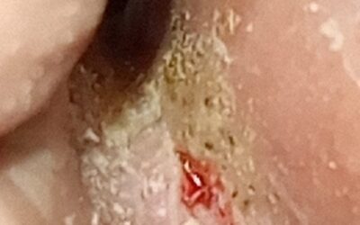 Micosis en la piel