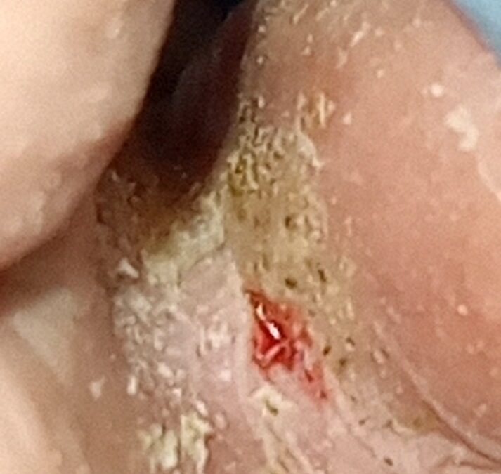 Micosis en la piel