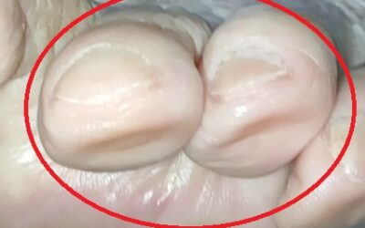 Indicios de que los pies se están apoyando de mala forma.
