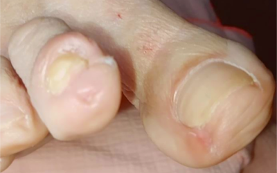 Hiperqueratosis, ejemplo.