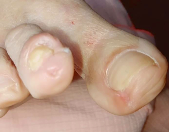 Hiperqueratosis, ejemplo.