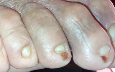 Hematomas debido a calzado en pie diabético.