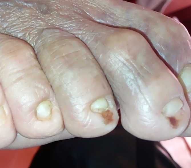 Hematomas debido a calzado en pie diabético.