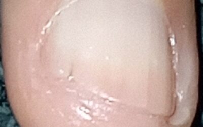 Fisura y quebradura en las uñas.