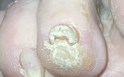Problemas en las uñas que se pueden complicar por la diabetes.