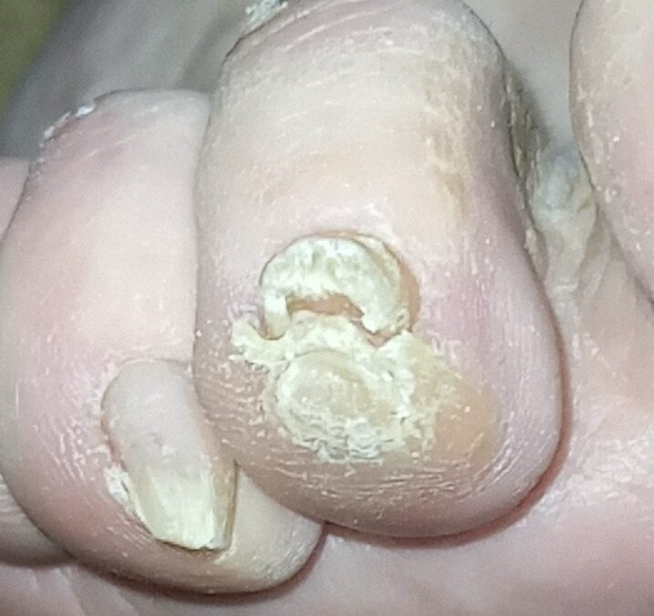 Problemas en las uñas que se pueden complicar por la diabetes.