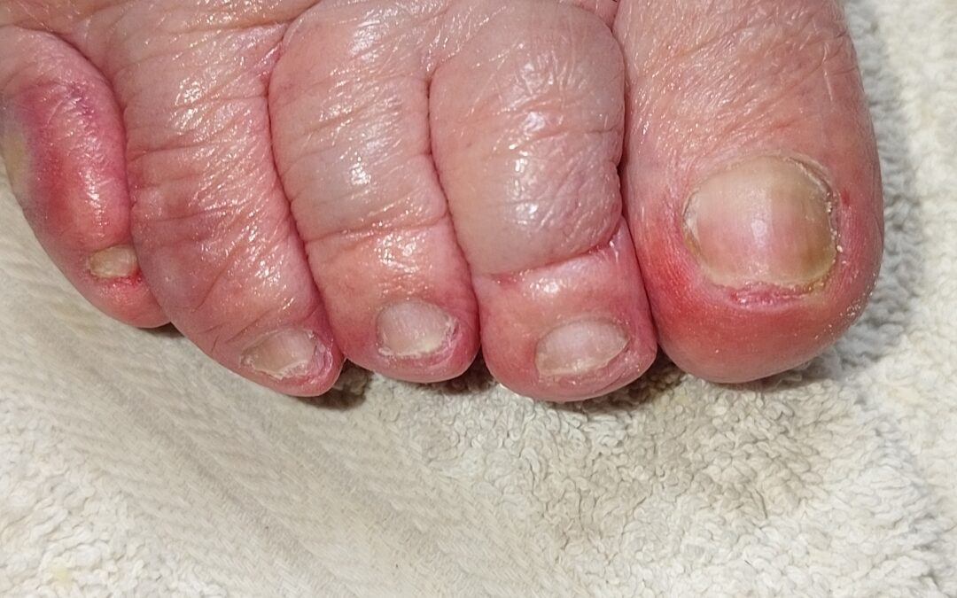 Edema MMII
