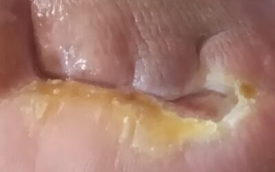 Las costras no deben ser retiradas. Aunque hay que re plantear esa verdad al momento de atender la herida en una persona con diabetes.