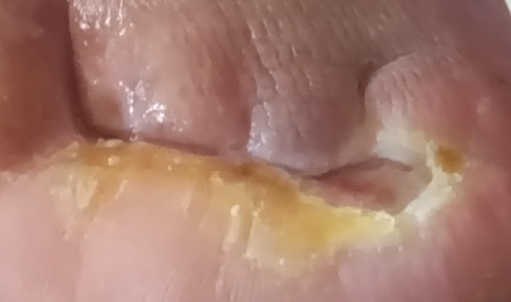Las costras no deben ser retiradas. Aunque hay que re plantear esa verdad al momento de atender la herida en una persona con diabetes.