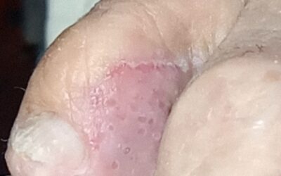 Cómo reconocer los hongos en la piel de los pies.
