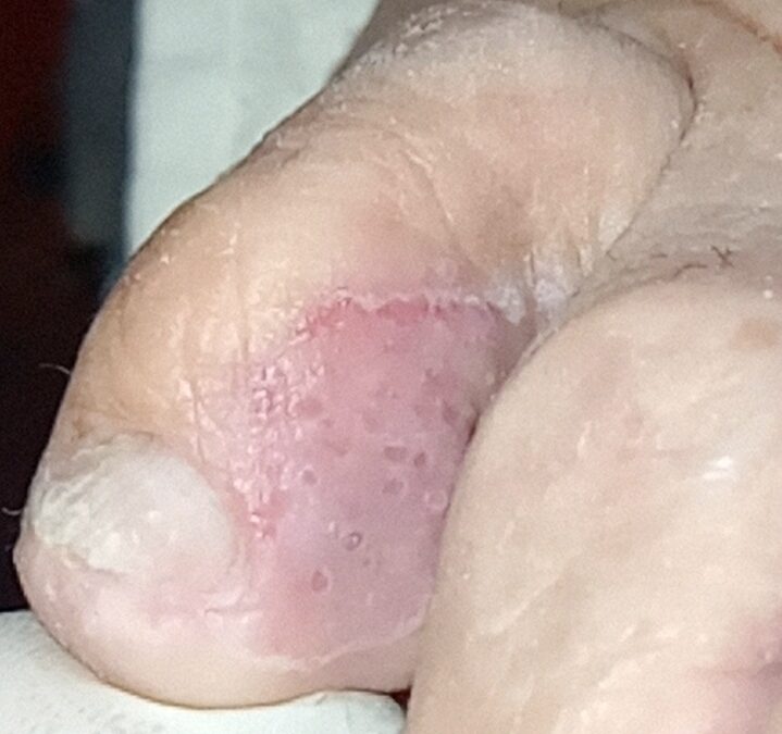 Cómo reconocer los hongos en la piel de los pies.