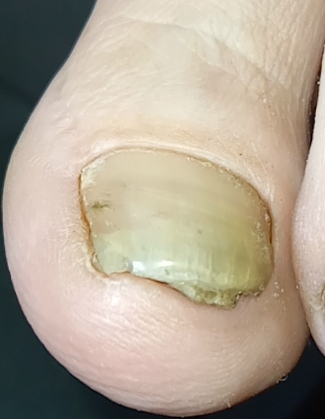 Tres problemas de uñas en un mismo pie.