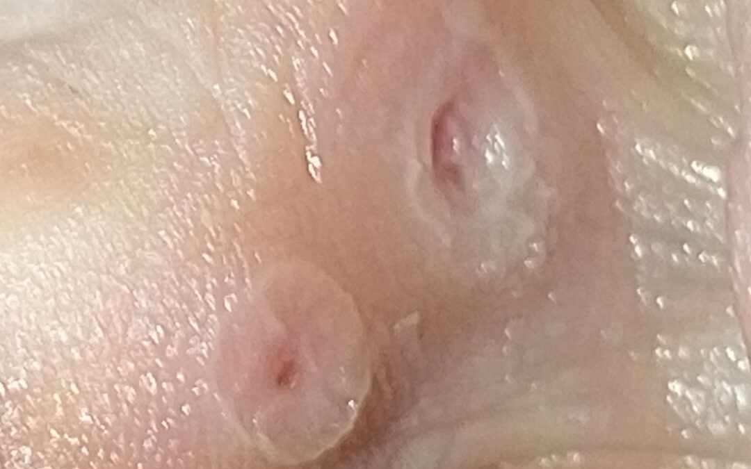 Dolor entre los dedos de los pies